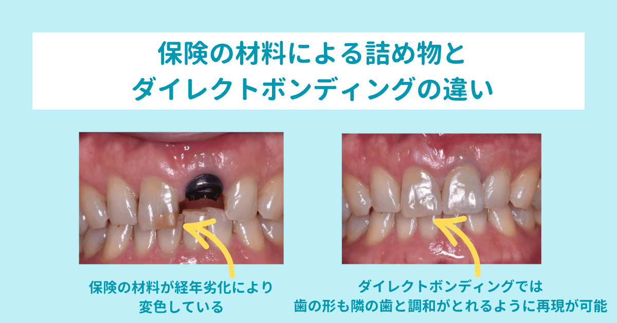 保険材料による詰め物とダイレクトボンディングの違い