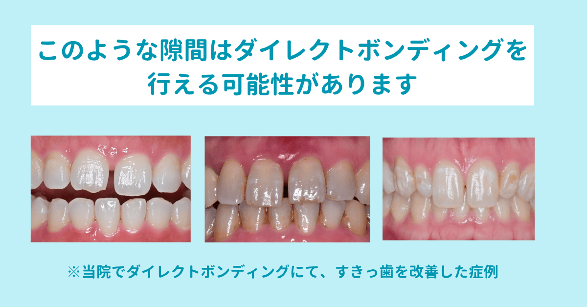 このような隙間はダイレクトボンディングを行える可能性があります