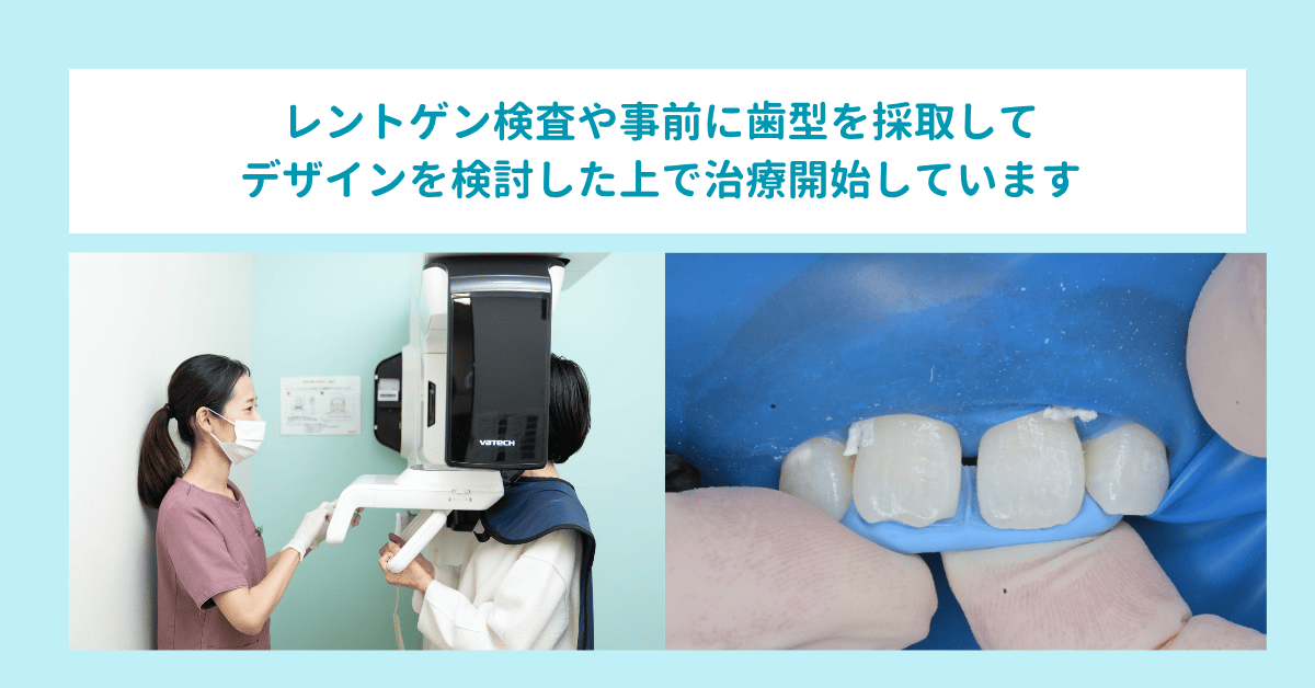レントゲン検査や事前に歯型を採取してデザインを検討した上で治療開始しています