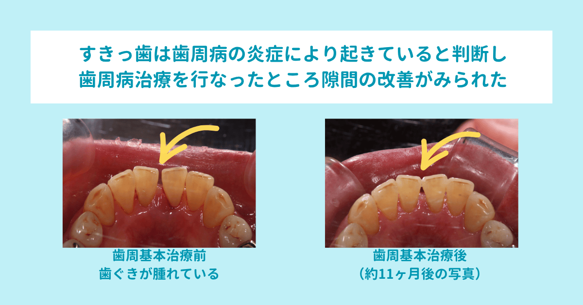 すきっ歯は歯周病の炎症により起きていると判断し歯周病治療を行ったところ隙間の改善が見られた